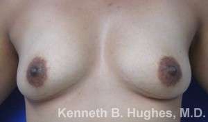 Breast Augmentation Implants Before & After Patient #7242