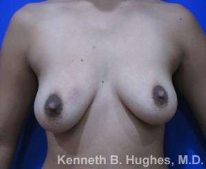 Breast Augmentation Implants Before & After Patient #7245