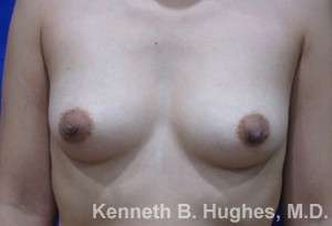 Breast Augmentation Implants Before & After Patient #7248