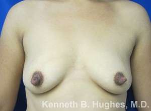 Breast Augmentation Implants Before & After Patient #7251