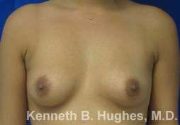 Breast Augmentation Implants Before & After Patient #7254
