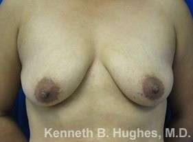 Breast Augmentation Implants Before & After Patient #7257
