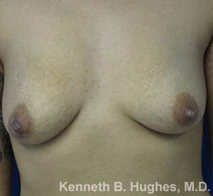 Breast Augmentation Implants Before & After Patient #7260