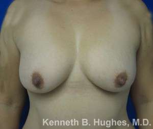 Breast Augmentation Implants Before & After Patient #7263