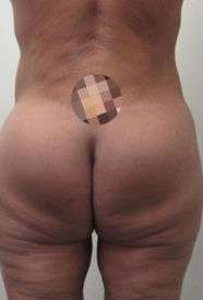 Body Lift Before & After Patient #5988
