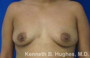 Breast Augmentation Implants Before & After Patient #7266