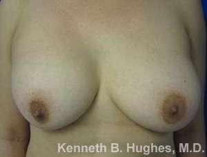Breast Augmentation Implants Before & After Patient #7269