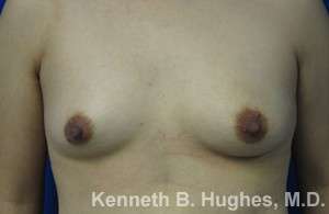 Breast Augmentation Implants Before & After Patient #7272