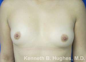 Breast Augmentation Implants Before & After Patient #7275