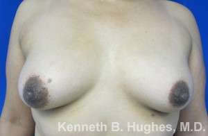Breast Augmentation Implants Before & After Patient #7278