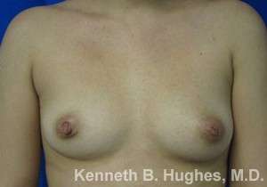 Breast Augmentation Implants Before & After Patient #7281