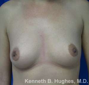 Breast Augmentation Implants Before & After Patient #7284