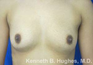 Breast Augmentation Implants Before & After Patient #7287