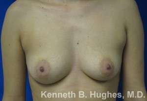 Breast Augmentation Implants Before & After Patient #7290