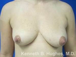 Breast Augmentation Implants Before & After Patient #7293