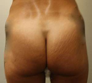 Body Lift Before & After Patient #5991