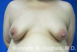 Breast Augmentation Implants Before & After Patient #7299