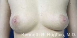 Breast Augmentation Implants Before & After Patient #7302