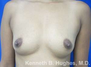 Breast Augmentation Implants Before & After Patient #7308