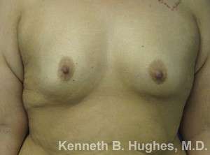 Breast Augmentation Implants Before & After Patient #7311