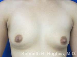 Breast Augmentation Implants Before & After Patient #7314