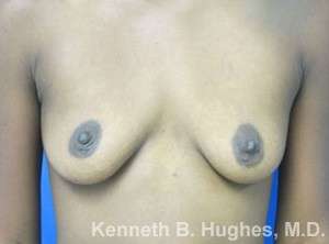 Breast Augmentation Implants Before & After Patient #7317