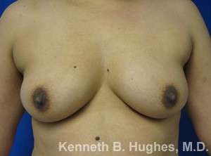 Breast Augmentation Implants Before & After Patient #7320
