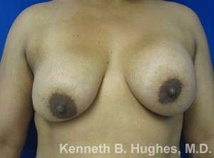 Breast Augmentation Implants Before & After Patient #7323