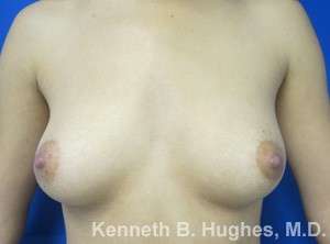 Breast Augmentation Implants Before & After Patient #7326