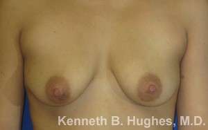 Breast Augmentation Implants Before & After Patient #7329