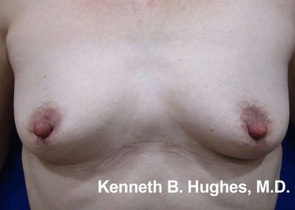 Breast Augmentation Implants Before & After Patient #7335