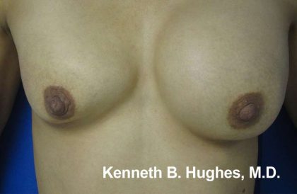 Breast Augmentation Implants Before & After Patient #7338