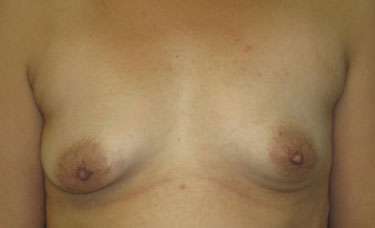 Breast Augmentation Implants Before & After Patient #7341