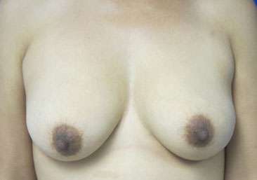 Breast Augmentation Implants Before & After Patient #7344