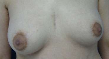 Breast Augmentation Implants Before & After Patient #7347