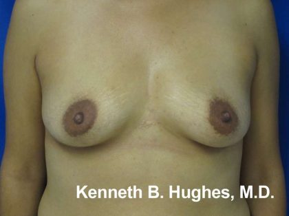 Breast Augmentation Implants Before & After Patient #7353