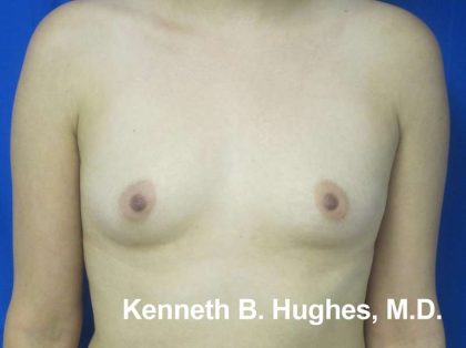 Breast Augmentation Implants Before & After Patient #7356