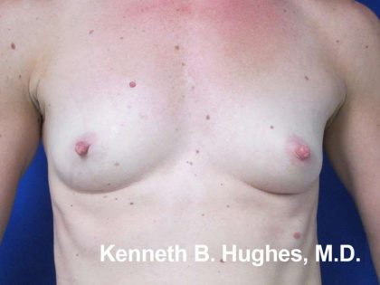 Breast Augmentation Implants Before & After Patient #7359