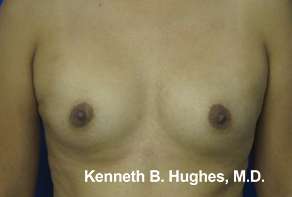 Breast Augmentation Implants Before & After Patient #7362