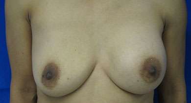Breast Augmentation Implants Before & After Patient #7365
