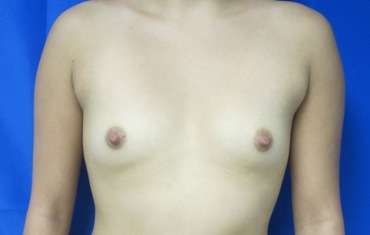 Breast Augmentation Implants Before & After Patient #7368