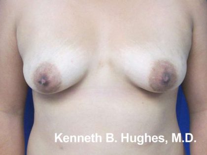 Breast Augmentation Implants Before & After Patient #7371