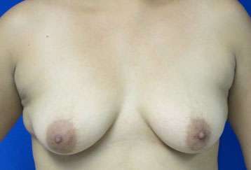 Breast Augmentation Implants Before & After Patient #7374