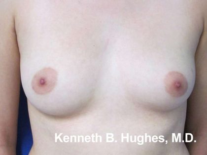 Breast Augmentation Implants Before & After Patient #7380