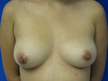 Breast Augmentation Implants Before & After Patient #7383