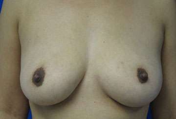 Breast Augmentation Implants Before & After Patient #7386