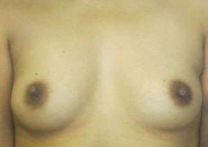 Breast Augmentation Implants Before & After Patient #7389