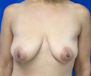 Breast Augmentation Implants Before & After Patient #7398
