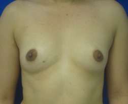Breast Augmentation Implants Before & After Patient #7401