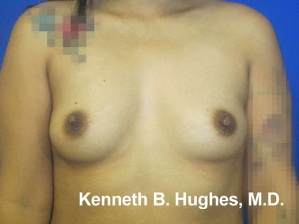 Breast Augmentation Implants Before & After Patient #7404